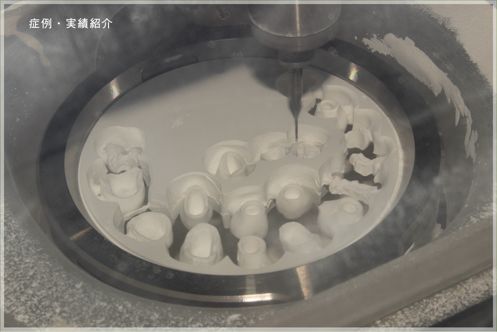 技工物作成イメージ